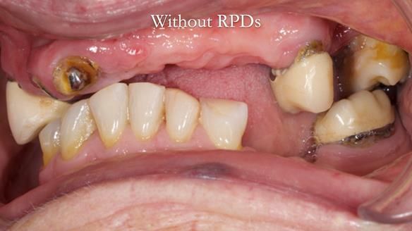 Eileen's transformation with upper and lower RPDs of Scandinavian hygienic design FULL PROTOCOL