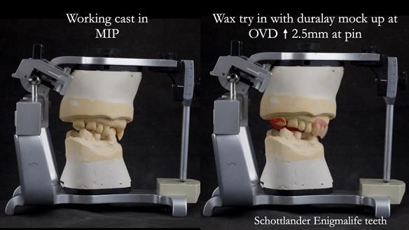 Read Newsletter 67 - Brian's COMBAT DENTURE Case Study