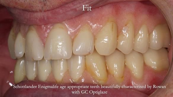 Newsletter 74: Ken’s Case Study Complete Dentures - Life Like and Age Appropriate