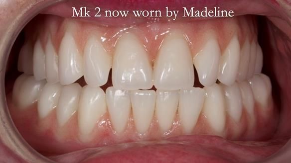 Replacing Madeline’s Complete denture FULL PROTOCOL