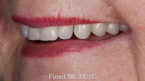 Replacing Madeline’s Complete denture FULL PROTOCOL