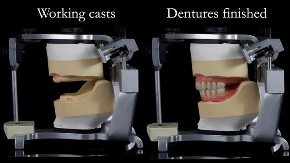 Newsletter 70 Complete Denture Treatment for Kate: A Case Study on Natural-Looking Dentures and Implant-Supported Overdentures