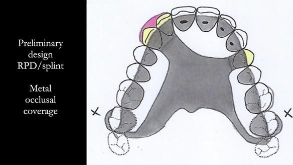 Read Newsletter 67 - Brian's COMBAT DENTURE Case Study