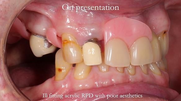 Managing Edgar “THE SCEPTIC” with an RPD/Splint FULL CASE