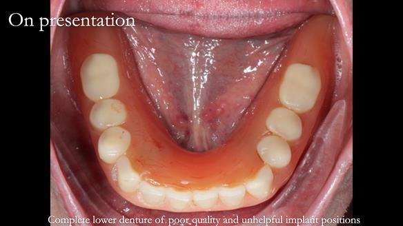 Newsletter 65 Marisa Provision of Complete Dentures on badly placed implants