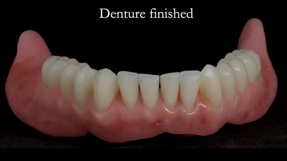 Newsletter 70 Complete Denture Treatment for Kate: A Case Study on Natural-Looking Dentures and Implant-Supported Overdentures