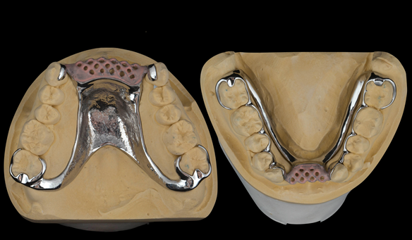 Figure 69 cobalt chromium framework - Scandinavian design - keeping the denture components 3mm away from the gingival margin