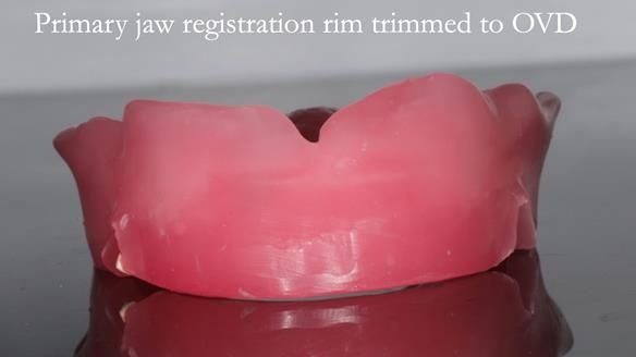 Newsletter 65 Marisa Provision of Complete Dentures on badly placed implants