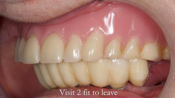 Newsletter 49 Managing Estelle’s failing implants with dentures FULL PROTOCOL