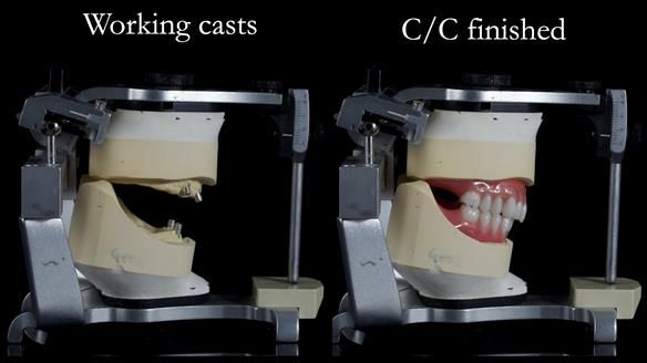 Newsletter 65 Marisa Provision of Complete Dentures on badly placed implants