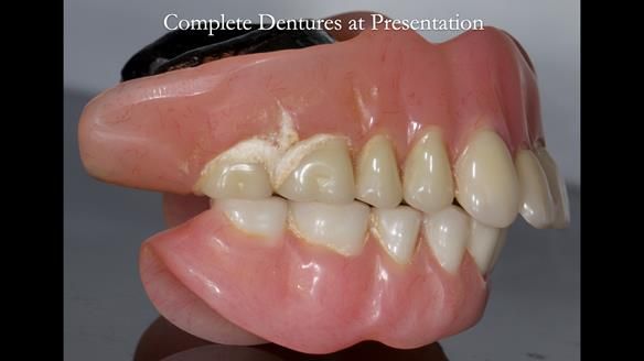 Newsletter 74: Ken’s Case Study Complete Dentures - Life Like and Age Appropriate