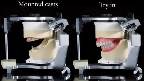 Newsletter 65 Marisa Provision of Complete Dentures on badly placed implants