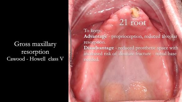 Newsletter 74: Ken’s Case Study Complete Dentures - Life Like and Age Appropriate