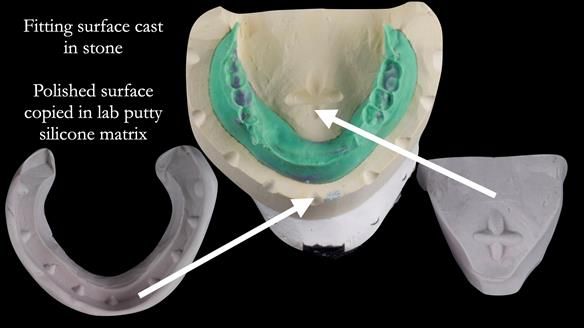 Replacing Madeline’s Complete denture FULL PROTOCOL