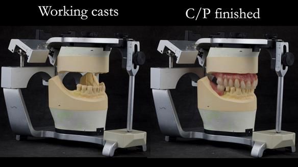 Solving Linda’s Failed “All on 4” implant bridges - full protocol Newsletter 42