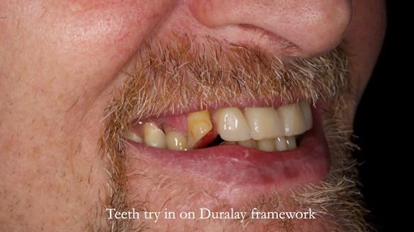 How Keith’s combat denture transformed his life – Newsletter 73