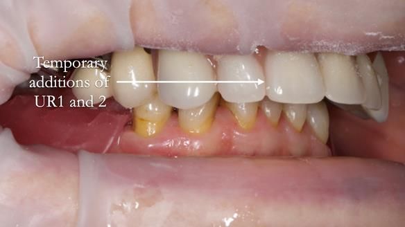 Eileen's transformation with upper and lower RPDs of Scandinavian hygienic design FULL PROTOCOL