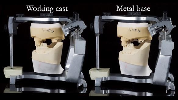 Managing Edgar “THE SCEPTIC” with an RPD/Splint FULL CASE