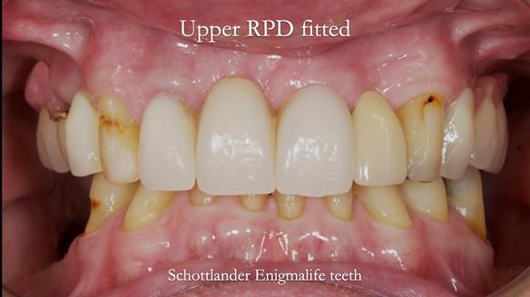 Managing Edgar “THE SCEPTIC” with an RPD/Splint FULL CASE