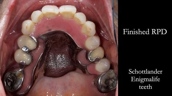 Eileen's transformation with upper and lower RPDs of Scandinavian hygienic design FULL PROTOCOL