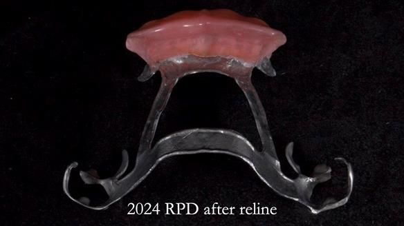 Newsletter 66 Long term case study. Life changing metal based RPD made for Anna