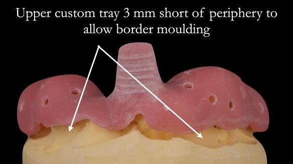 Eileen's transformation with upper and lower RPDs of Scandinavian hygienic design FULL PROTOCOL