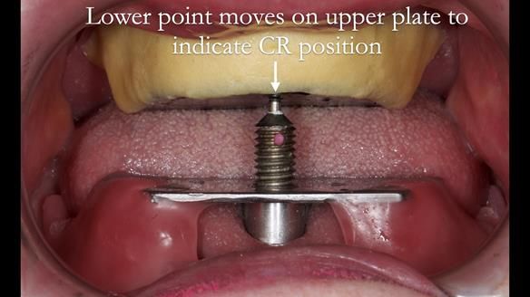 Replacing Madeline’s Complete denture FULL PROTOCOL