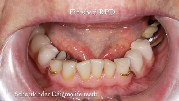 Eileen's transformation with upper and lower RPDs of Scandinavian hygienic design FULL PROTOCOL