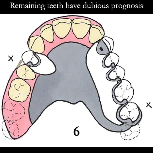 Universal Scandinavian partial denture designs