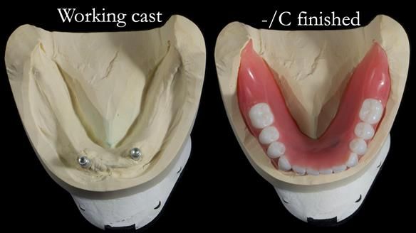 Newsletter 65 Marisa Provision of Complete Dentures on badly placed implants