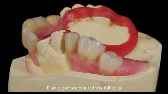 How Keith’s combat denture transformed his life – Newsletter 73