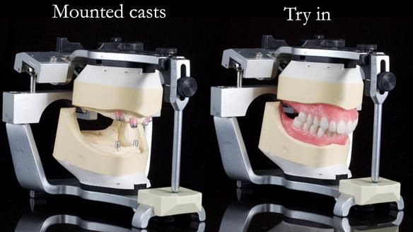 Newsletter 65 Marisa Provision of Complete Dentures on badly placed implants