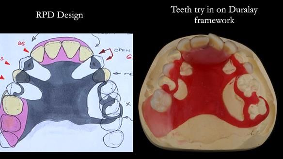 Newsletter 71 Jean’s Class I Mod III RPD: See my mistakes Fractured Mk1 to a Stronger Mk2 RPD (4 years on)