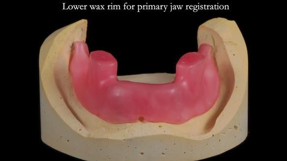 Newsletter 65 Marisa Provision of Complete Dentures on badly placed implants