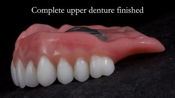 Newsletter 65 Marisa Provision of Complete Dentures on badly placed implants