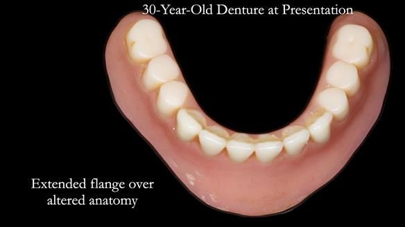 Newsletter 68 Restoring Jan’s Smile: Complete Dentures Inspired by Her Daughter’s Teeth - Post Mouth Surgery