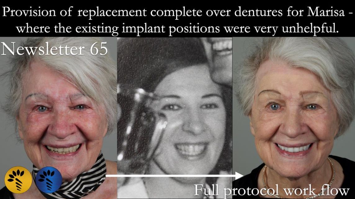 Newsletter 65 Marisa Provision of Complete Dentures on badly placed implants
