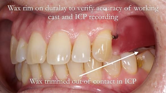 Solving Sue's failed implants with metal based RPD - full protocol Newsletter 43