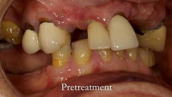 Eileen's transformation with upper and lower RPDs of Scandinavian hygienic design FULL PROTOCOL