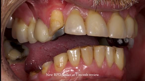 How Keith’s combat denture transformed his life – Newsletter 73