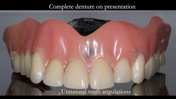 Newsletter 74: Ken’s Case Study Complete Dentures - Life Like and Age Appropriate