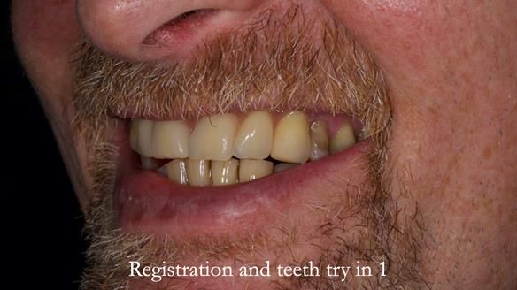 How Keith’s combat denture transformed his life – Newsletter 73