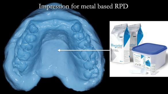 Newsletter 66 Long term case study. Life changing metal based RPD made for Anna