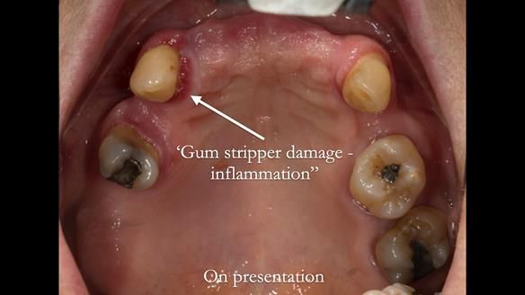 Newsletter 71 Jean’s Class I Mod III RPD: See my mistakes Fractured Mk1 to a Stronger Mk2 RPD (4 years on)