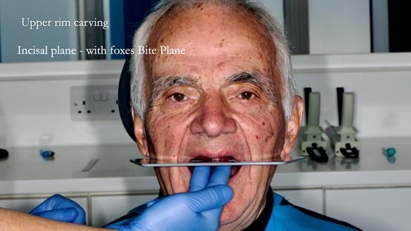 Newsletter 74: Ken’s Case Study Complete Dentures - Life Like and Age Appropriate