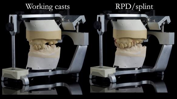 Read Newsletter 67 - Brian's COMBAT DENTURE Case Study