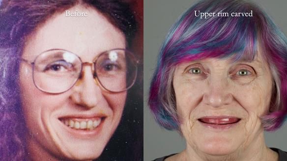 Newsletter 70 Complete Denture Treatment for Kate: A Case Study on Natural-Looking Dentures and Implant-Supported Overdentures