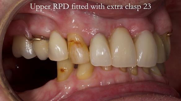 Managing Edgar “THE SCEPTIC” with an RPD/Splint FULL CASE