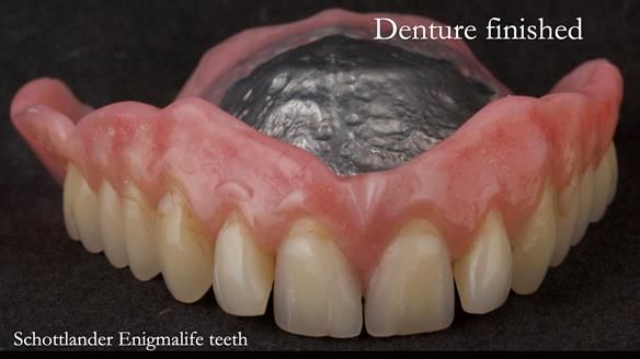 Newsletter 74: Ken’s Case Study Complete Dentures - Life Like and Age Appropriate