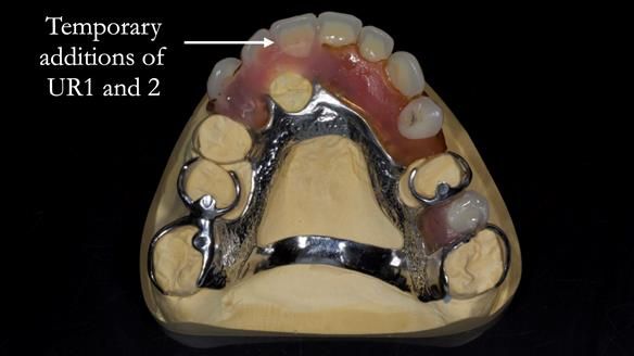 Eileen's transformation with upper and lower RPDs of Scandinavian hygienic design FULL PROTOCOL